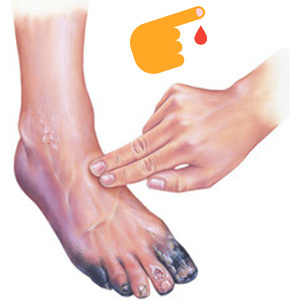 Желтеют, слоятся и отваливаются: о каком заболевании «кричат» ногти на ногах?