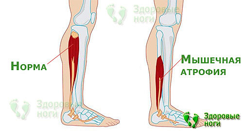 Атрофия мышц является одной из причин, почему болят ноги при сахарном диабете