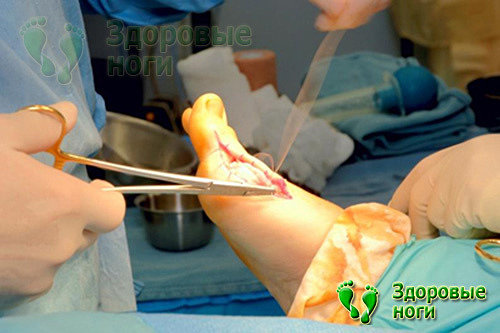 Удаление шишки на большом пальце ноги оперативным путем