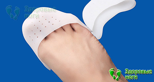 Лечение молоткообразных пальцев ног должно сочетаться с защитой суставов от натирания обувью