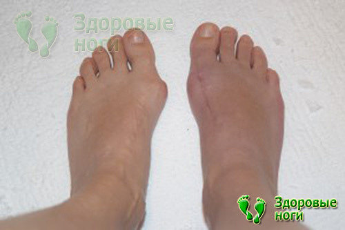 Возле большого пальца ноги удаление шишки с помощью операции достаточно эффективно