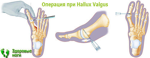 Операция Hallux Valgus