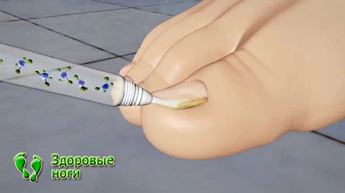 Лак для лечения грибка ногтей