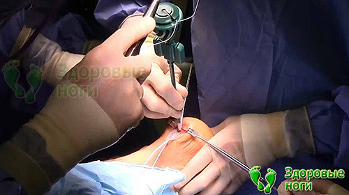 Удаление хирургическим путем пяточной шпоры проводится под наркозом