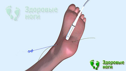 Вы можете купить ортопедические подпяточники при пяточной шпоре в нашем интернет-магазине с доставкой по всей России