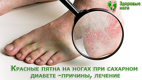 При сахарном диабете красные пятна на ногах могут появляться на стопе и в районе голени