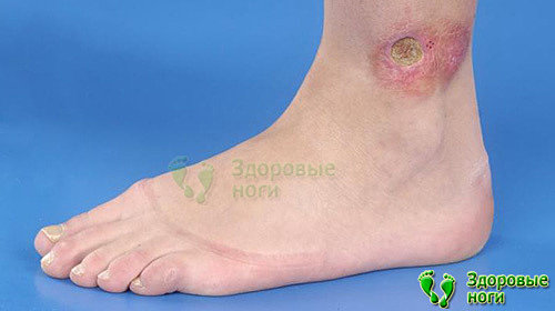 Вследствии развития липоидного некробиоза при диабете могут появится красные пятна на голени ног