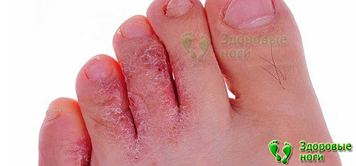 Поражение грибковыми инфекциями может давать покраснение пальцев на ногах при диабете