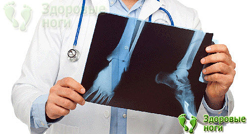 При пяточной шпоре рентген-снимок поможет назначить правильное лечение