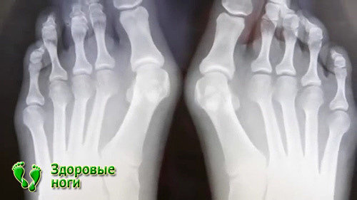 Диагностика шишки на ноге обычно проводится на основе рентгеновского снимка.