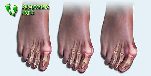 В зависимости от тяжести заболевания шишку на ноге возле большого пальца разделяют на 4 степени.