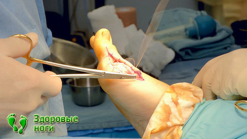 Если шишка на ноге растет с каждым днем и большой палец уже внахлест со вторым, то может потребоваться операция.