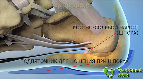 При ходьбе облегчить боль при пяточной шпоре помогут ортопедические подпяточники или стельки