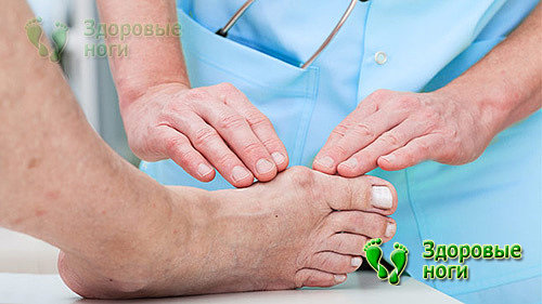 Фиксирующий корректор довольно часто применяется для лечения вальгусной деформации большого пальца стопы.