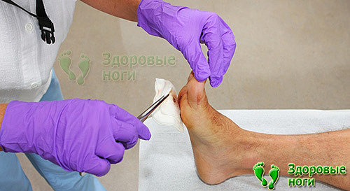 Часто язвы на ногах при сахарном диабете требуют хирургического лечения