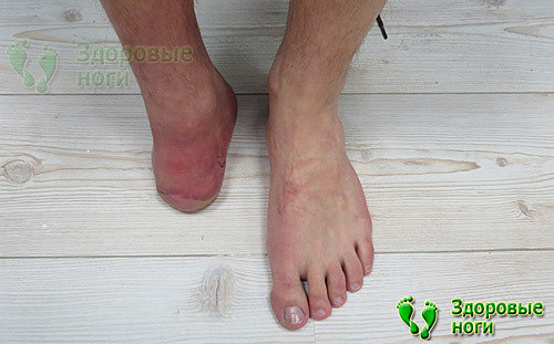 У больных сахарным диабетом простая язва на пальце ноги может привести к ампутации конечности