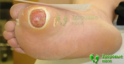 Особо опасна при сахарном диабете гнойная рана на ноге