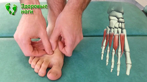 Лечебный массаж при вальгусной и плосковальгусной деформации стопы ног