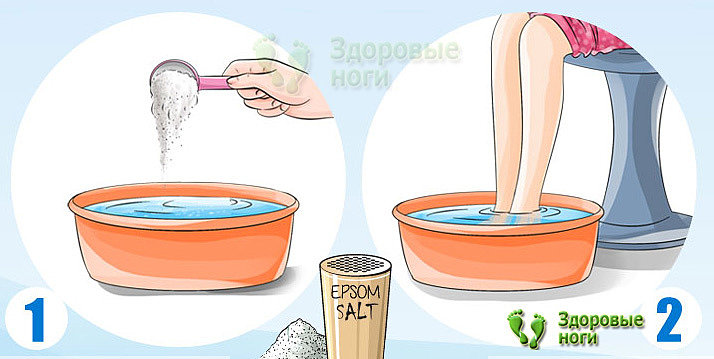 При пяточной шпоре солевые ванночки оказывают обезбаливающий и противовоспалительный эффект