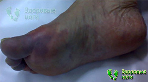 За воспаление ног при диабете можно принять такое опасное заболевание, как тромбоэмболия пальцевых сосудов