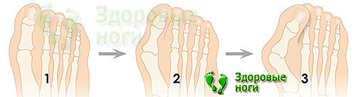 Много отзывов в интернете о результатах операции на косточке большого пальца ноги