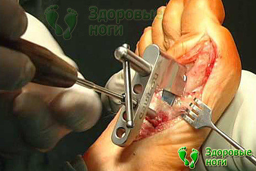 Реконструктивная операция косточек на ногах оставляет большие шрамы