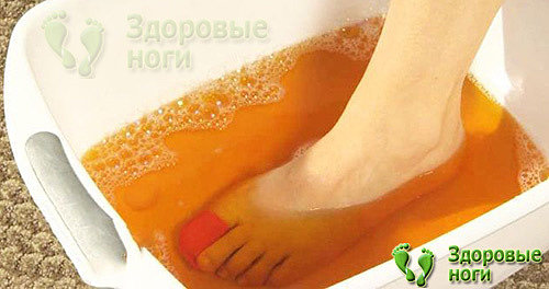 Лечение пяточной шпоры уксусом производится также с помощью ванночек для ног