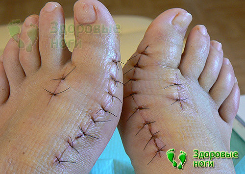 Оперативное вмешательство по удалению косточек на пальцах ног может оставить большие шрамы на коже