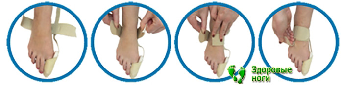 При косточках хорошо поможет бандаж отводящий для большого пальца стопы