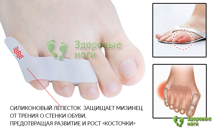 Разделители пальцев стопы с защитой косточки мизинца защищают пальцы от натирания и трения