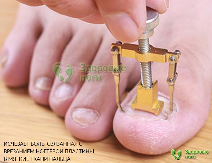 Купить инструмент для вросших ногтей в интернет-магазине Здоровые Ноги