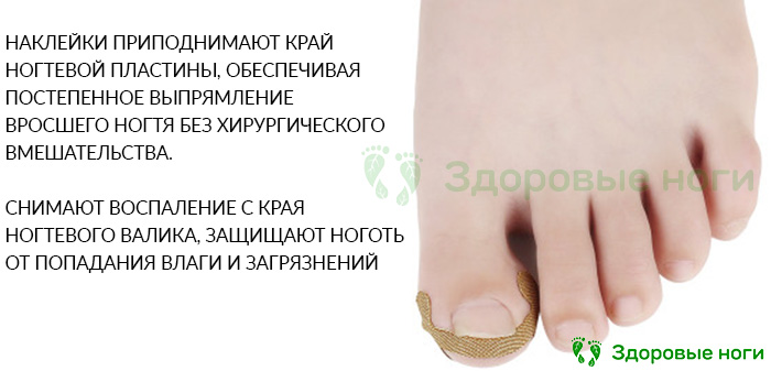 Купить набор наклеек для коррекции вросших ногтей в интернет-магазине Здоровые Ноги