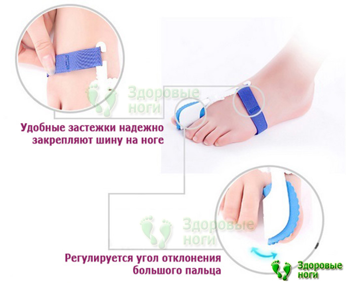 Для большого пальца ноги ночной бандаж применяется для устранения косточки