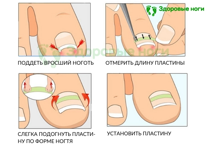 пластины для коррекции ногтей без хирургического вмешательства