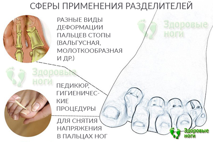 Разделители для пальцев ног для педикюра также применимы и при деформациях пальцев стопы