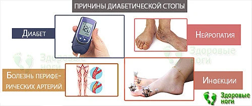 Причины появления диабетической стопы обусловлены нейропатией и патологией кровеносных сосудов