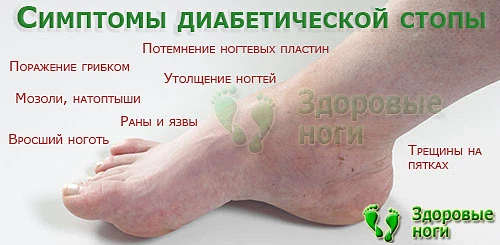 Всем диабетикам необходимо знать симптомы диабетической стопы