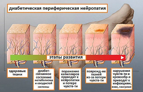 Всего различают 5 стадий диабетической стопы