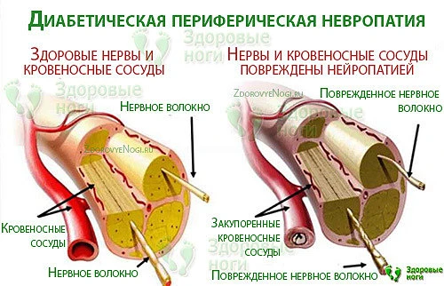 Самой распространенной является нейропатическая форма диабетической стопы