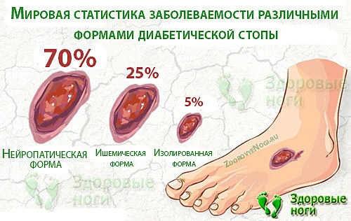 Согласно статистике, нейроишемическая форма диабетической стопы встречается в 25% случаев