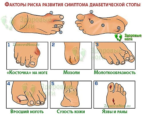 При наличии данных симптомов необходимо лечение начальной стадии диабетической стопы