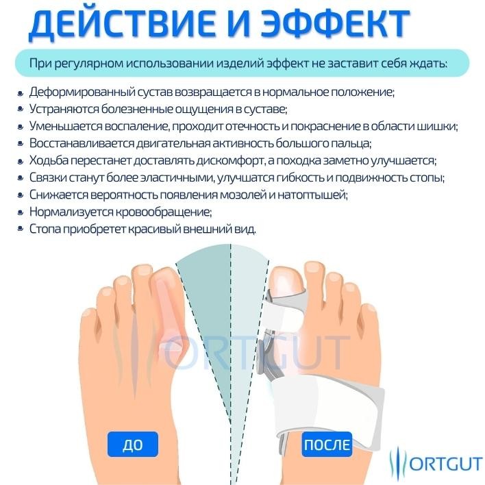 Вальгусная шарнирная шина с регулировкой угла отклонения ORTGUT ROTATE ...