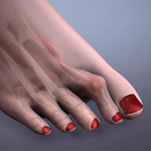 Молоткообразная, когтеобразная деформация пальцев ног. ТОП-10 корректоров