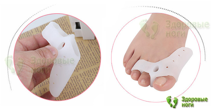 Для лечения молоткообразной деформации применяйте силиконовый бурсопротектор с защитой косточки от натирания Для лечения молоткообразной деформации применяйте силиконовый бурсопротектор с защитой косточки от натирания