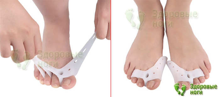 Отзывы о бурсопротекторе при молоткообразной деформации говорят о его высокой эффективности Отзывы о бурсопротекторе при молоткообразной деформации говорят о его высокой эффективности