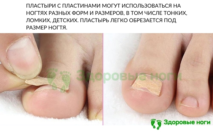 Пластырь для вытягивания краев вросшего ногтя Пластырь для вытягивания краев вросшего ногтя
