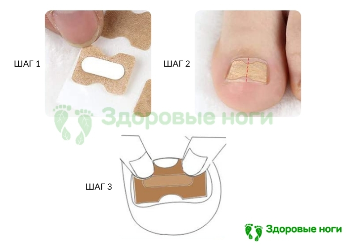 Пластыри для исправления вросших ногтей Пластыри для исправления вросших ногтей