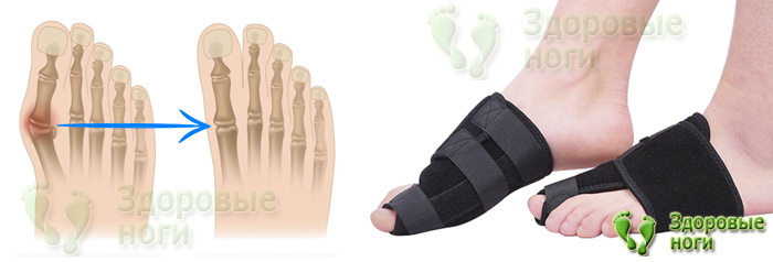 Для коррекции косточки на ноге тканевая вальгусная шина будет очень эффективна Для коррекции косточки на ноге тканевая вальгусная шина будет очень эффективна